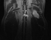 peripheral nerve sheath tumor DOR T1 post fs