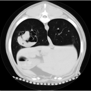 CT Lung window