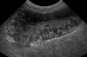 Mucocele