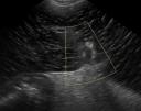 Splenic torsion