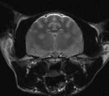 MRI brain