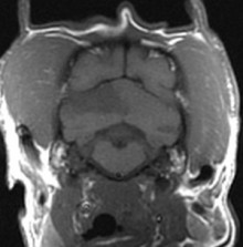 MRI brain