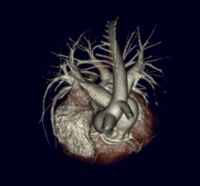 3D heart