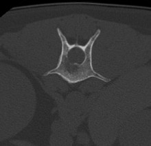 ct_spine
