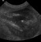 transverse kidney