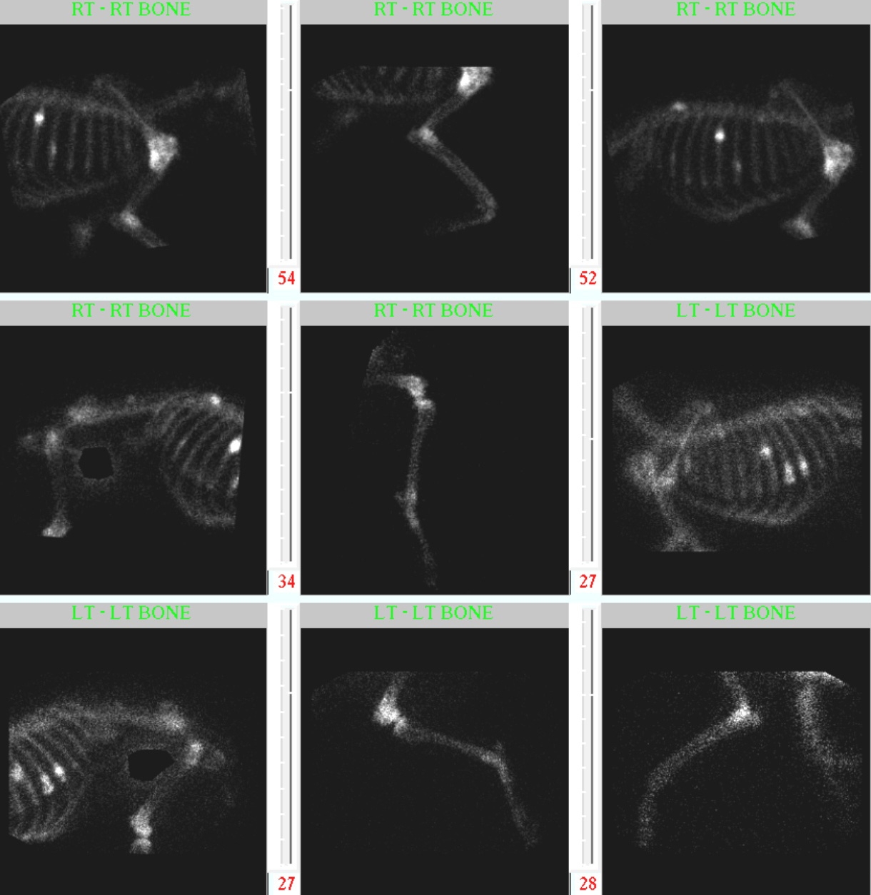 Nuclear Scintigraphy Skeleton