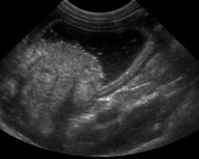 Abdominal ultrasound