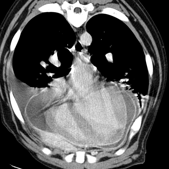 pericarditis