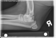 R LAT Elbow