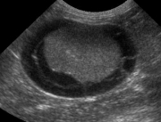 4_R_kidney_us_full