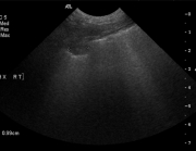 Thoracic ultrasound