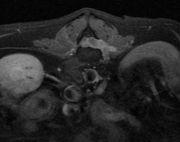 peripheral nerve sheath tumor AX T1 post fs