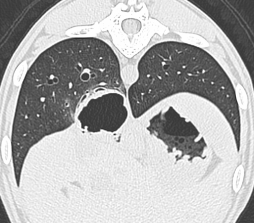 CT Abscess