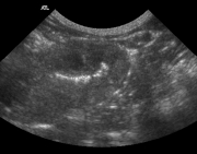 Ultrasound