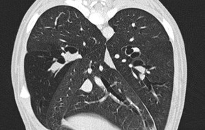 CT thorax