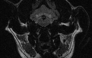 mri_brain