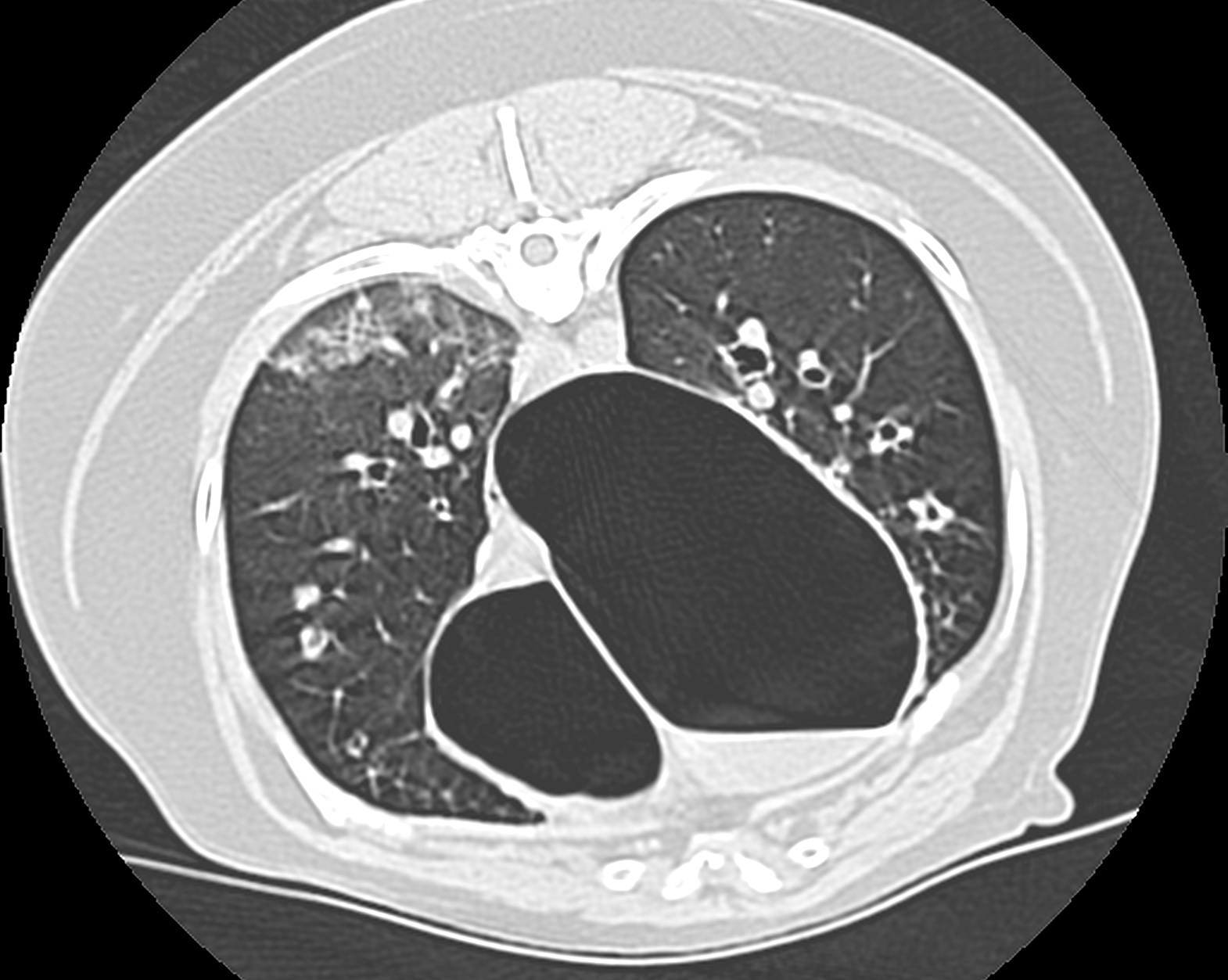 CT Bronchiectasis Bulla