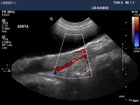 Ultrasound Aorta