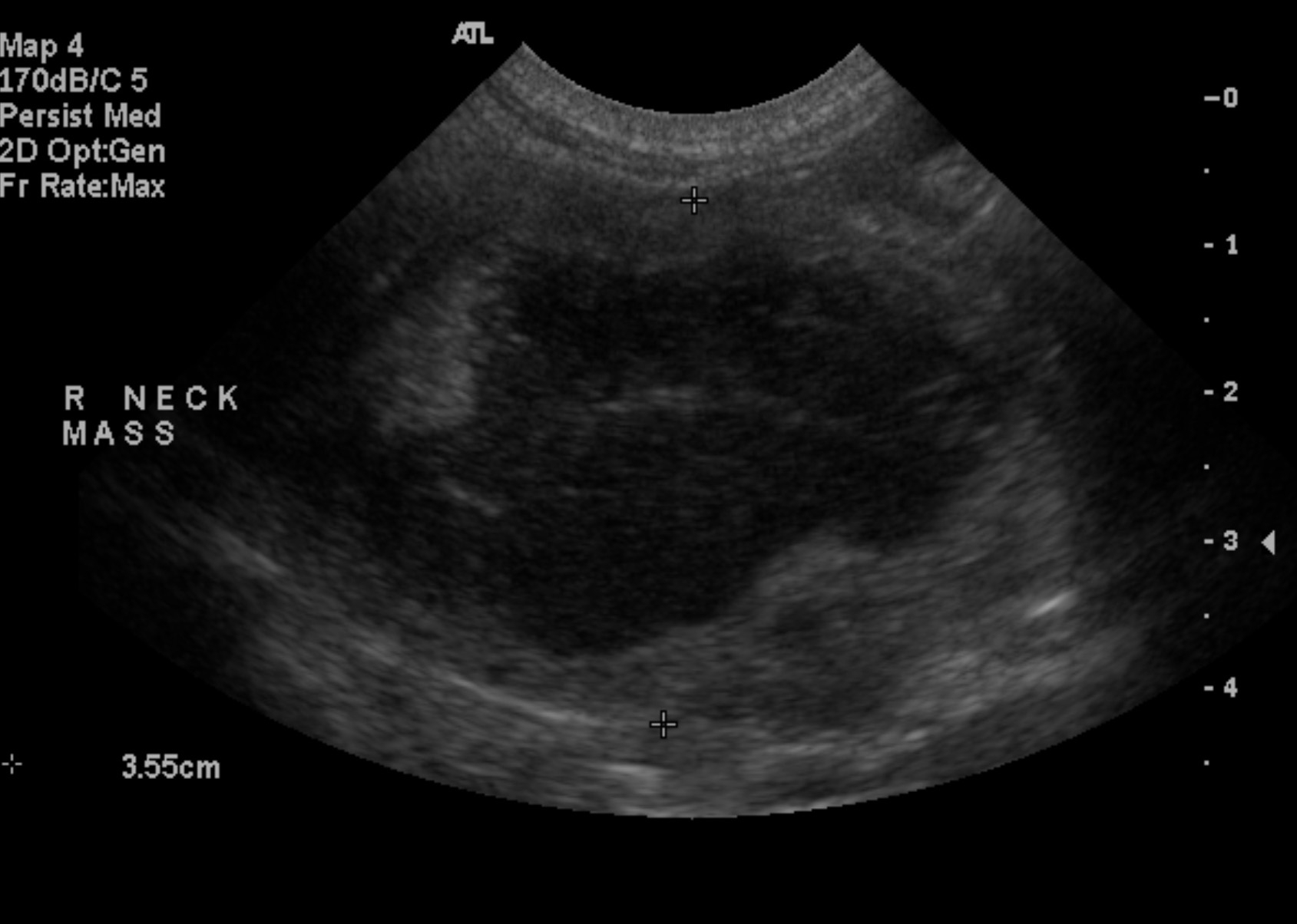 Neck Ultrasound