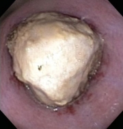 esophageal foreign body