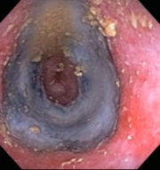 esophageal necrosis