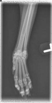 Thoracic Limb-L AP Fore