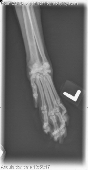 Thoracic Limb-L AP Fore