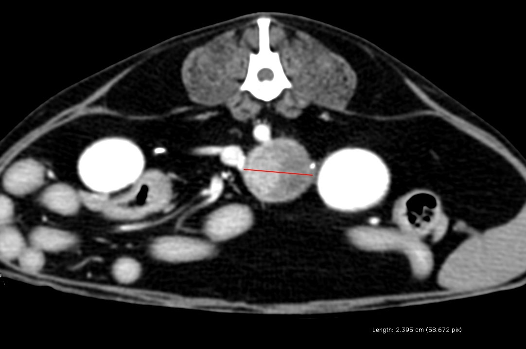 left adrenal carcinoma