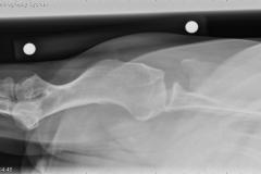 R PA Shoulder
