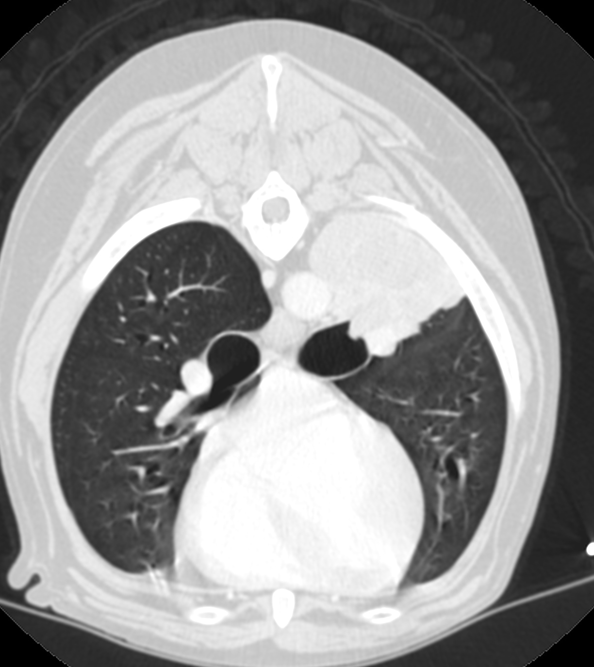 Pulmonary Carcinoma POST CONTRAST