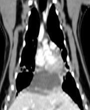 CT Dorsal