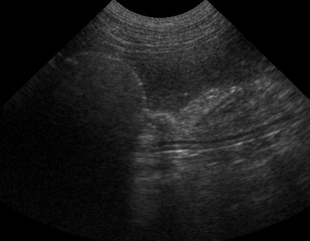 Ultrasound